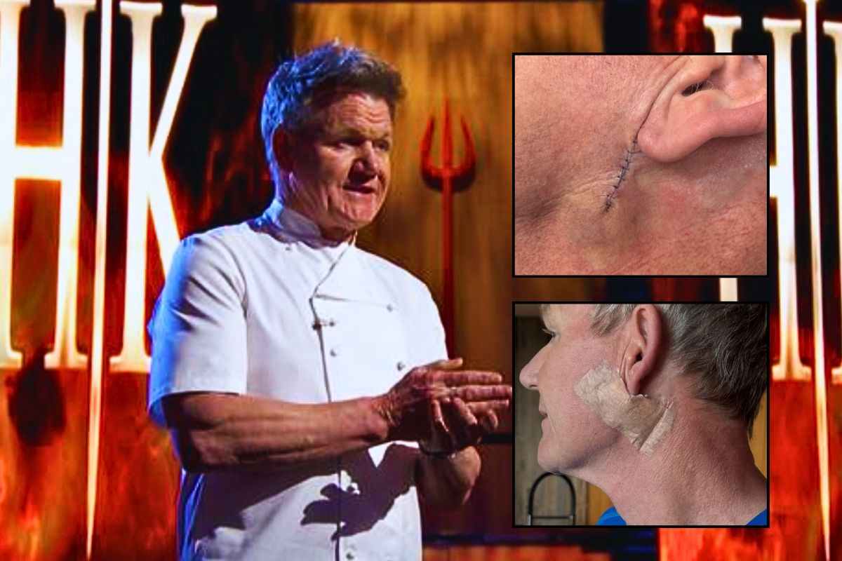 La cicatrice mostrata sui social da Ramsay